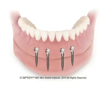 dentures graphic